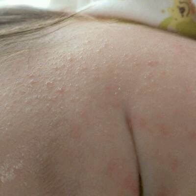 宝宝20天的时候满身起了湿疹,像鸡皮疙瘩一样,特别是腿上还很硬,摸着