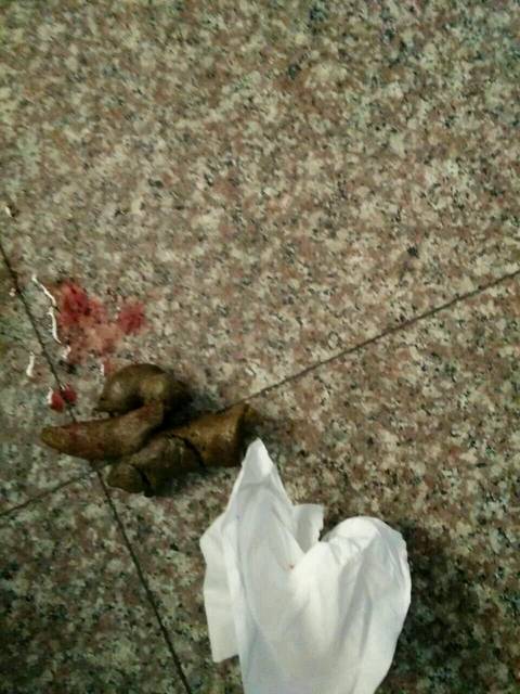 9个月宝宝严重便秘,求救!_便便出血,3天一次,很