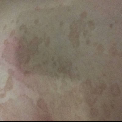 怀孕后胸下面肚子上就有这个了,不疼不痒,洗完澡就不怎麼能看到了,这