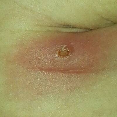 宝宝四个多月了,腋下起了个脓包,今天上面白色