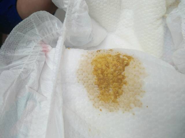 便便有9种颜色,只有3种是健康的(附健康九色卡