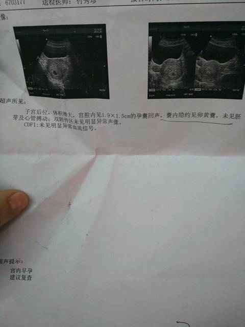 月经周期长,没见胎芽_月经周期45天,今天停经