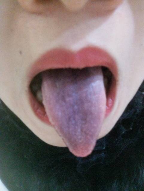 开心_孕前期感冒了舌头变紫黑色了啥情况哦