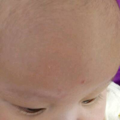 宝宝脑门上长好多痘痘,有的还有白色的跟粉刺