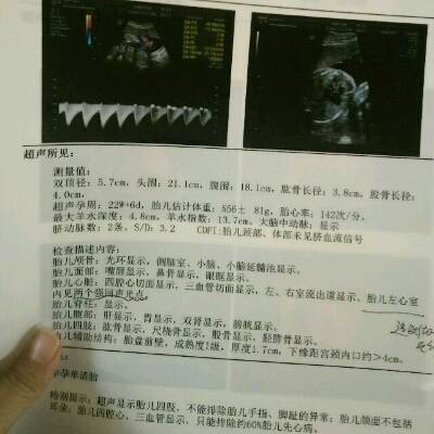 唐氏筛查低风险,其他都没什麼问题,就是四维彩超检查胎儿左心房见两个