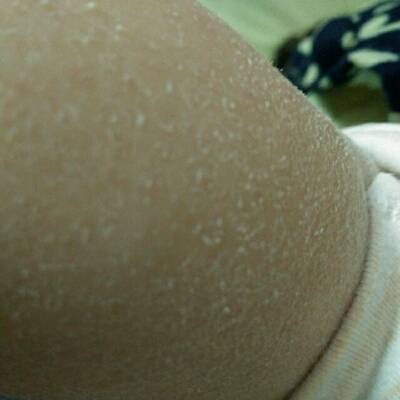 1岁宝宝今年冬天皮肤干燥起皮痒,是什么皮肤病