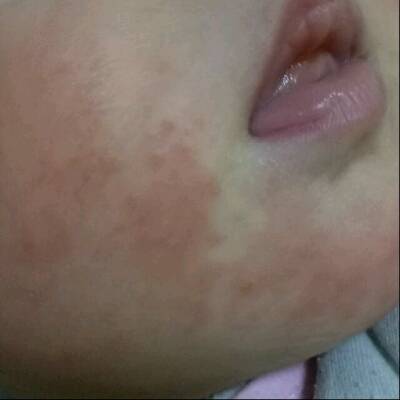 一个多月的宝宝脸上起了湿疹可以抹药膏吗?帮忙看看是
