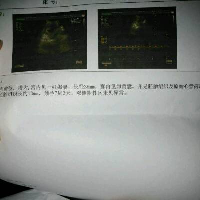 我今天怀孕7周3天有咖啡色分泌物,去医院检查