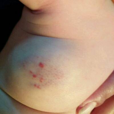 宝宝左肩下方长有鸡蛋大小血管瘤,满月时只有淤青一块平的,现在成凸起