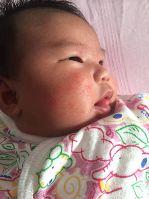 求助!宝宝脸上起疹子怎么办_宝宝刚开始脸上长