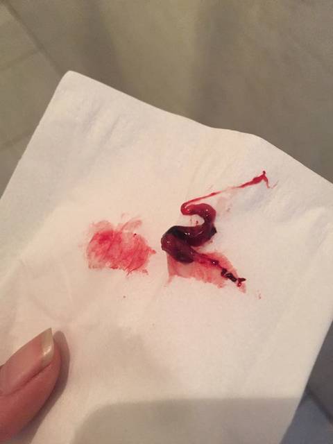 生化妊娠第六天排出一块肉体一样的东西_这是