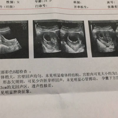 孕52天,B超显示孕囊形体欠规则,见少许胎芽回