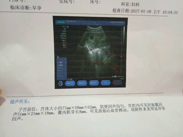 都说B超单可以看男女_怀二胎啦。顺产过后大