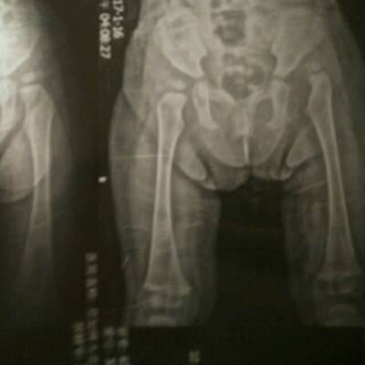 我的宝宝盆骨发育不良,导致左腿骨错位,只能做
