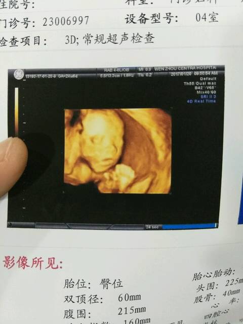 胎儿左侧多囊泡肾_我怀孕24+了,昨天做了三维
