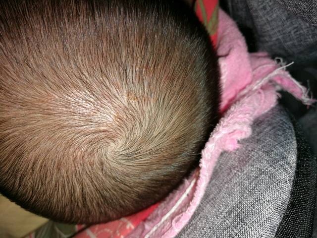 五个半月宝宝头皮上长了一块像藓一样的_开始