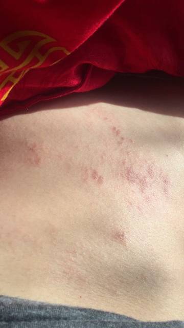 肚子痒…还有一些像蚊子包一样的疙瘩,_有没有