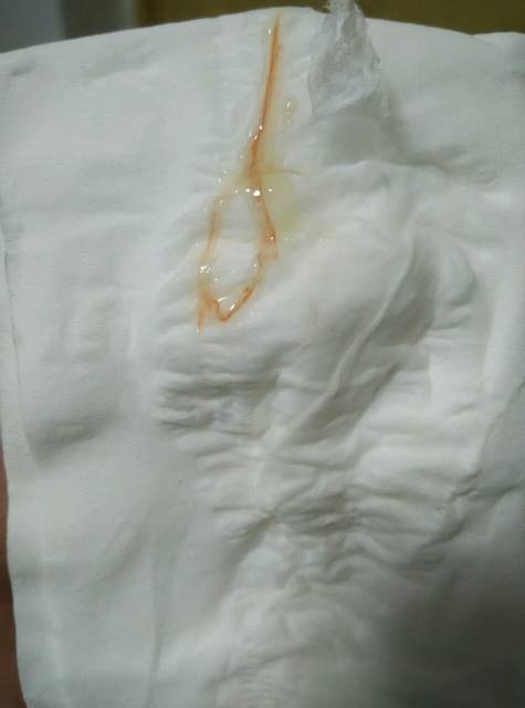 小便分泌物有血丝,无宫缩无其他症状,是见红么