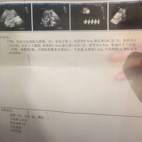 双胎26 周 b超显示胎盘覆盖宫颈内口 有没有一样的