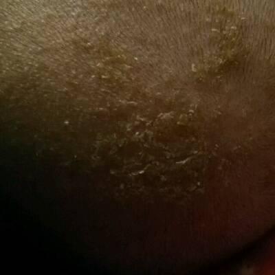 宝宝头上的是脂溢性湿疹吗?有图