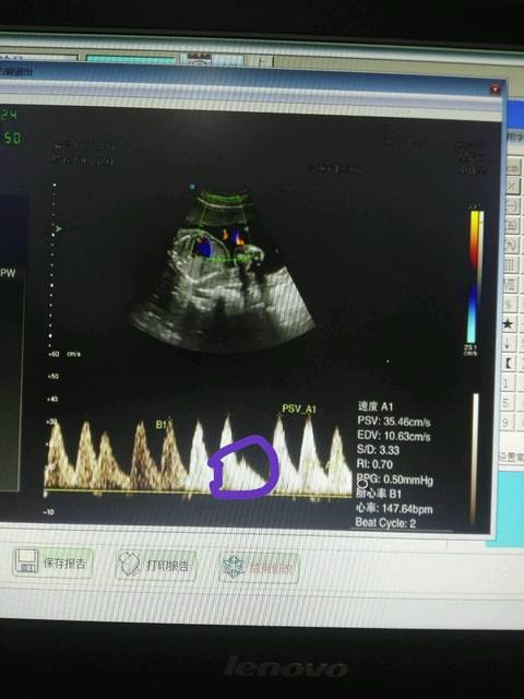 23周+2拍的四维彩超 胎儿心率偶尔早搏