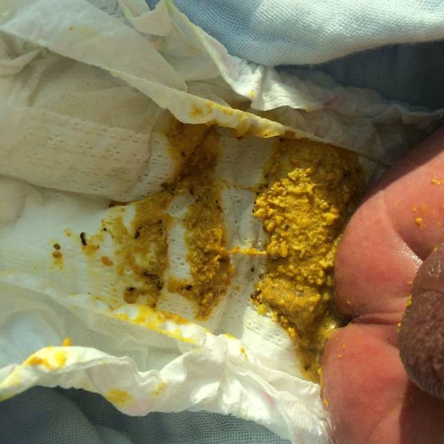 有经验的宝妈!_今天发现宝宝拉出来的屎有黑色颗粒状