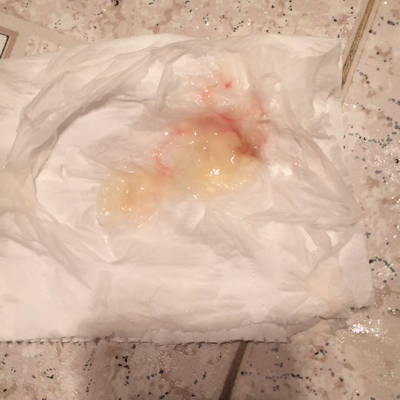 今天上厕所流果冻状分泌物带血丝。还有19天