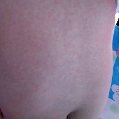 宝宝身上起红点,这是湿疹吗?两天前发烧吃了吗