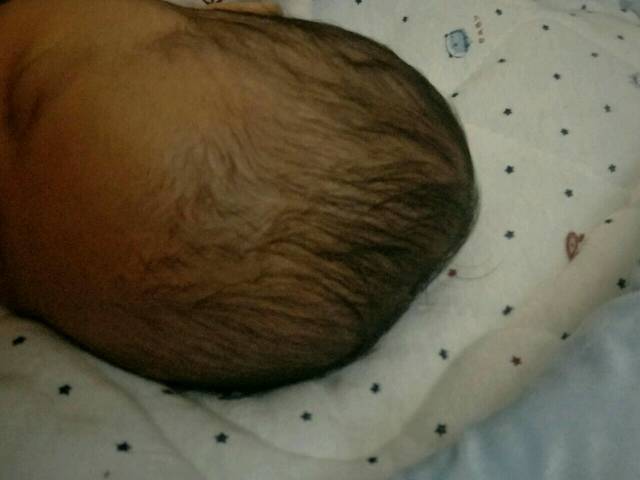 新生儿头上有个软包_我家宝宝刚出生就发现左