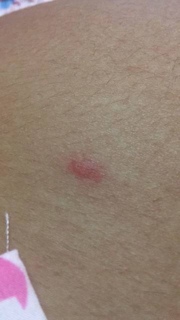 被螨虫咬了吗?_身上都是这种一颗颗的,去看医