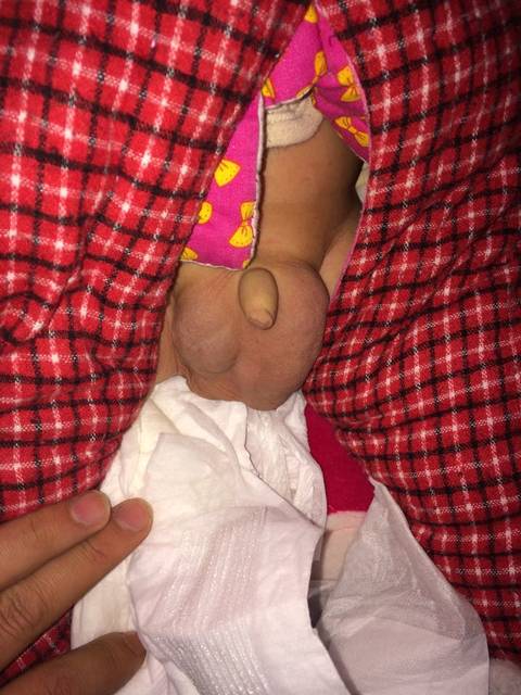 宝宝疝气怎么办?_4个半月宝宝有疝气，之前不严重，这两天发烧_宝宝树