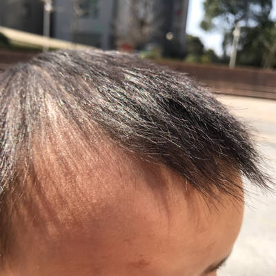 宝宝两岁,一岁时额头上长了色素斑,晒太阳颜色
