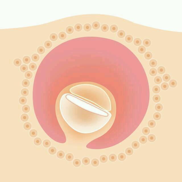 怀孕伴有阴道炎_怀孕4周+4天，前几天感觉阴道炎，像豆腐渣样_宝宝树