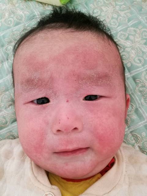 宝宝四个月,湿疹一直不好_宝宝脸上,头上,耳朵