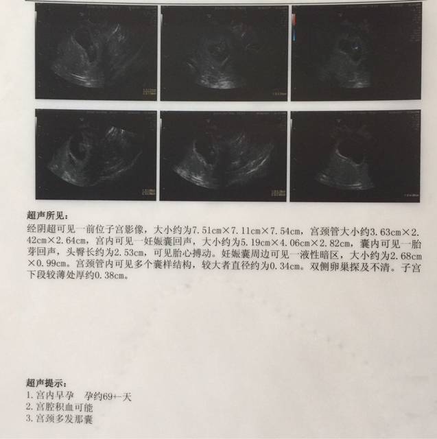 孕酮还是低,hcg也低,B超宝宝发育正常!_吃了两