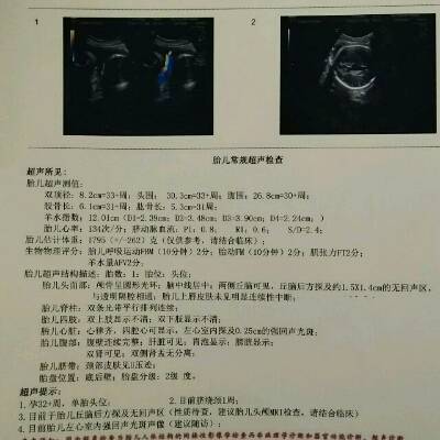 孕32周 B超显示胎儿丘脑后方探及1.5*1.4无回