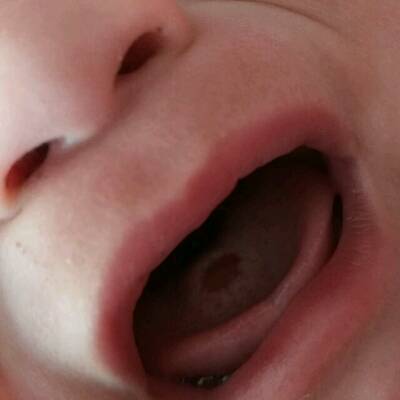 男宝宝5个多月 这两天舌头上有一个红点 是什麼
