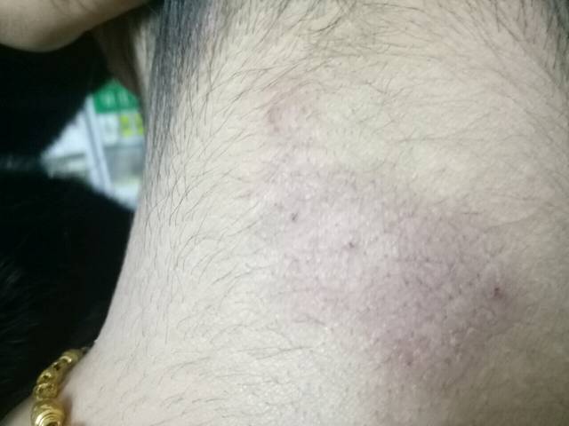 孕十一周张癣了怎么办_怀孕十一周+,脖子上张