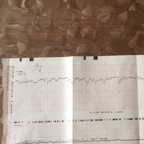 胎心监护7分不过关.