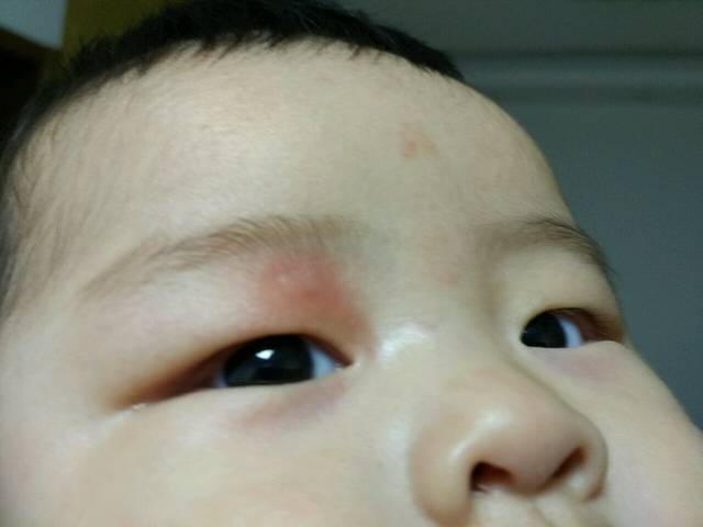 孩子眼皮出现像被蚊子咬了一样的红包怎么回事
