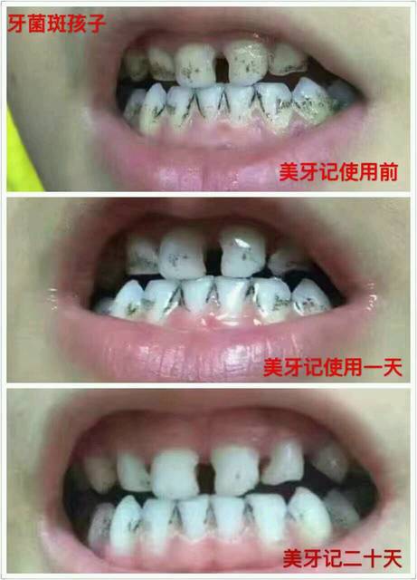 一岁半宝宝牙齿上有洞图片