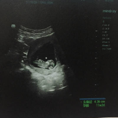求懂的帮忙看看是男孩还是女孩!11周2天.孕囊大小是8.5x4.9x5.