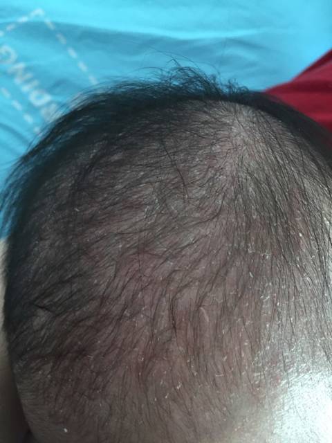 宝宝2个月21天,头上有类似油脂粒的东西。_一