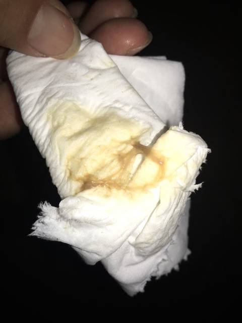 急→孕初期每天都有黄褐色分泌物怎么办_我怀