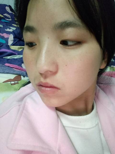 产后脸上雀斑黑点点痣越来越多怎么办_没生宝