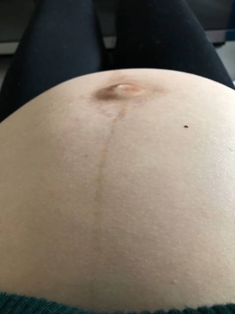 肚脐这样是男孩女孩啊?_肚脐撑的都是妊辰纹