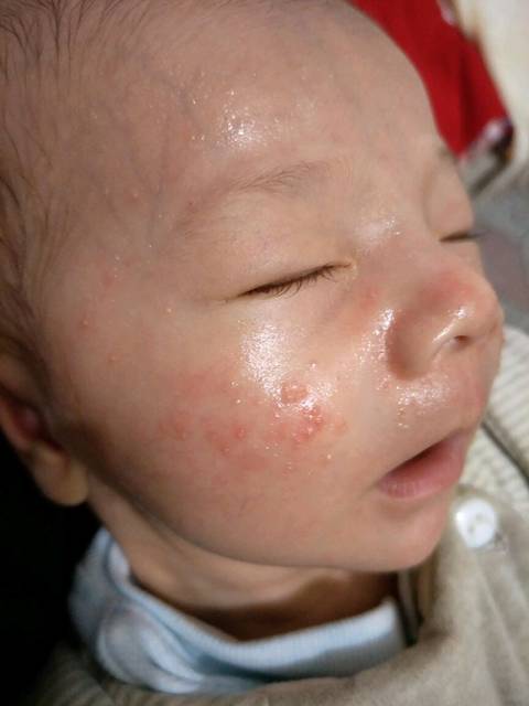 !_宝宝34天,脸上有小白点,发红还有白头。感觉