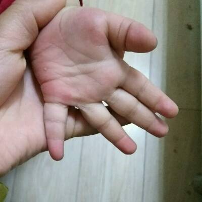 我家宝宝手掌两侧跟指头肚发红,有时候浅一些,有时候重一些,有知道