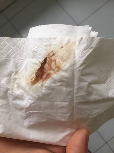请教一下!我老婆怀孕一个月!有褐色分泌物是怎麼回事!我们都担心死了!