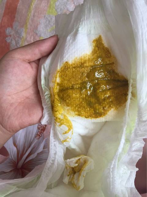 有图,宝宝大便_从昨天开始拉大便味道就特别酸